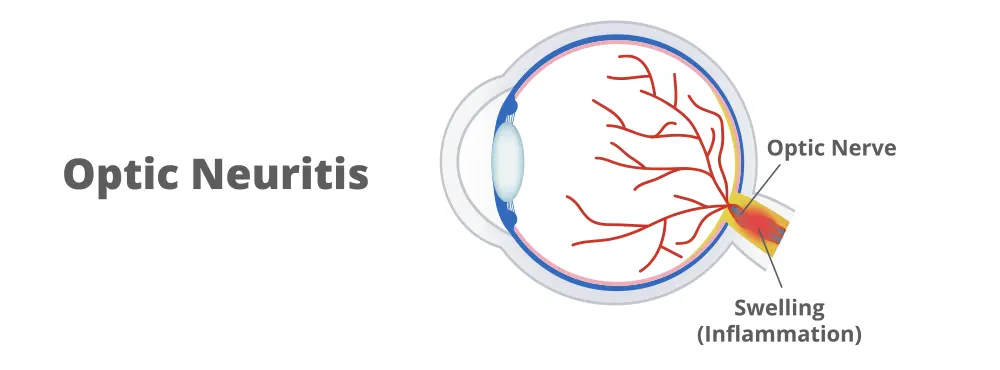 Optic Neuritis